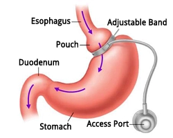 Gastric Band Kirurgi