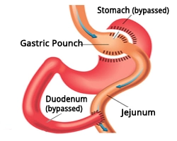 Gastric Bypass Kirurgi