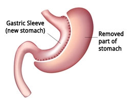 Gastric Sleeve Kirurgi