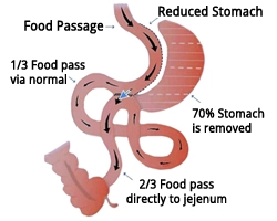 Loop-Todelings Kirurgi